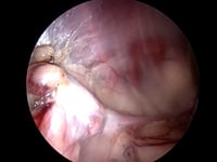 EVR Adhesion of ovarian remnant to abdominal wall and pancreas dog