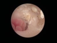 EVR polypoid masses coming from middle ear cat