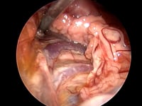 EVR exploratory diagnostic laparoscopy cat with neutrophilic cholangitis