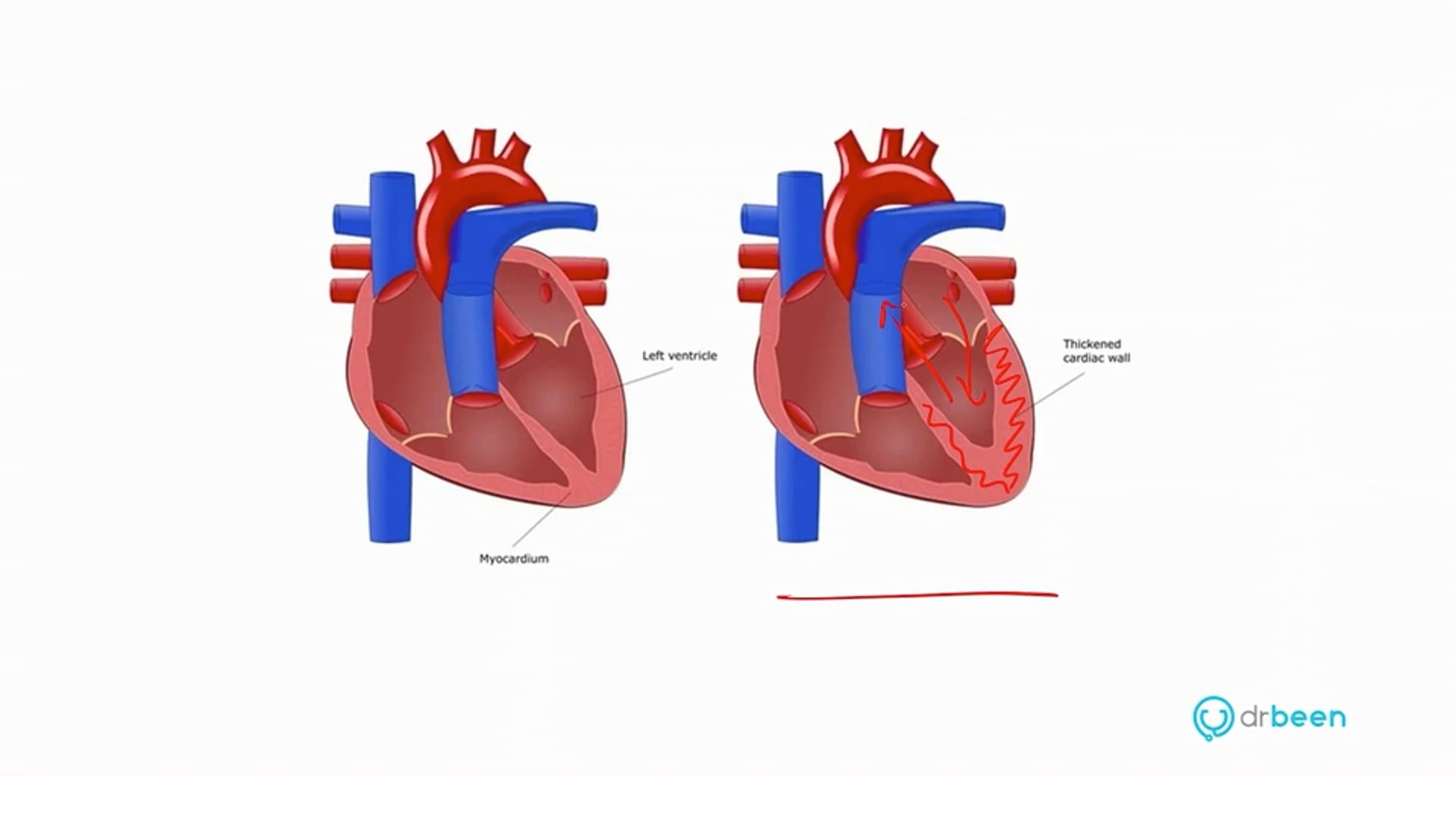 Hypertrophic Cardiomyopathy (Dr. Bhatti)