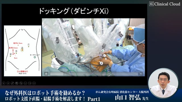 なぜ外科医はロボット手術を勧めるか？ロボット支援下直腸・結腸手術を解説します！ Part1