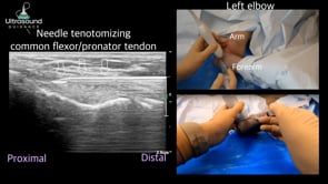 Common Flexor Tendon Needle Tenotomy