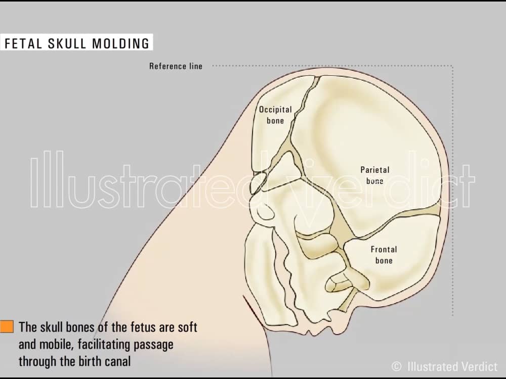 Fetal skull molding during birth on Vimeo