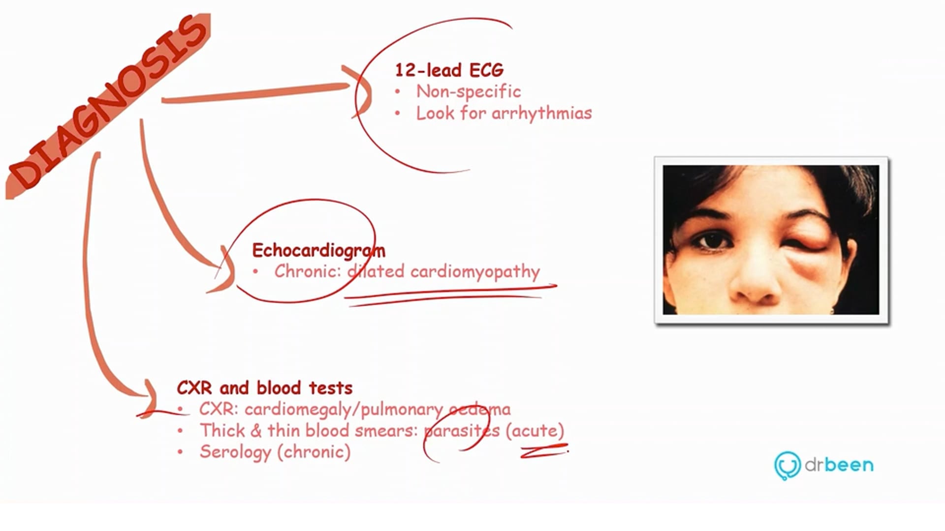  Chagas Disease (Dr. Bhatti)