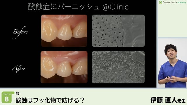 酸蝕はフッ化物で防げる?│Step4-8