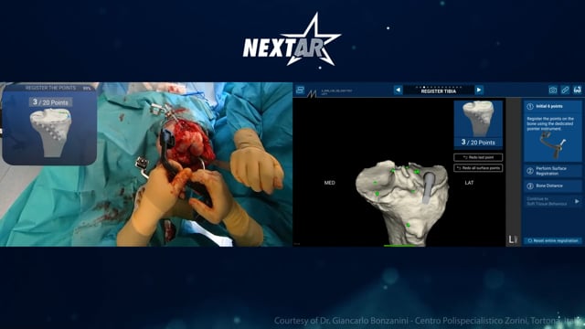 NextAR Knee Live Surgery: Dr. G. Bonzanini