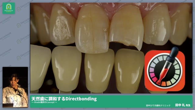 天然歯に調和するDirectbonding -Shade選択のConcept– #1 田中 礼先生