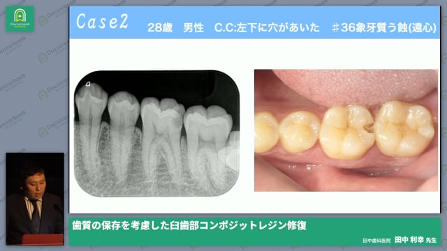 歯質の保存を考慮した臼歯部コンポジットレジン修復 #2 田中 利幸先生