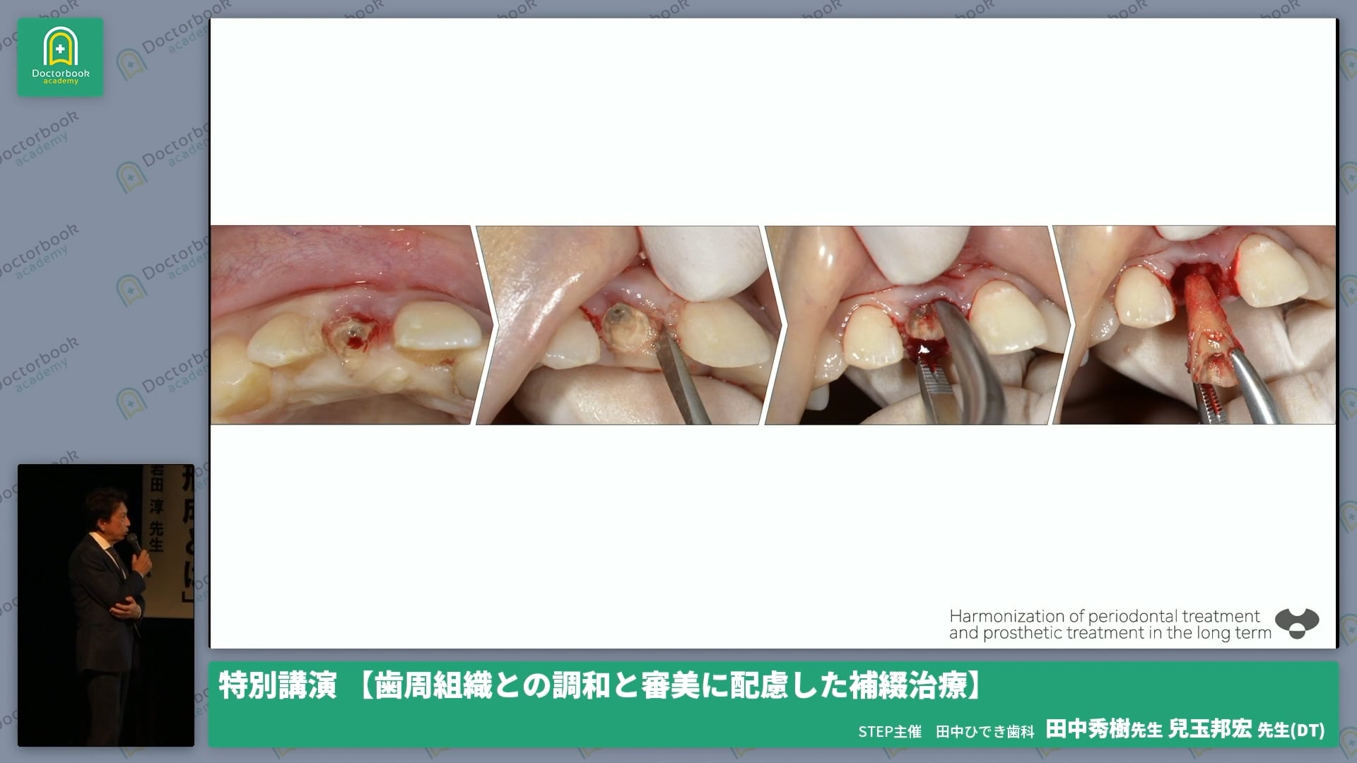 歯周組織との調和と審美に配慮した補綴治療│14th STEP ANNUAL MEETING with R & PABC 特別講演