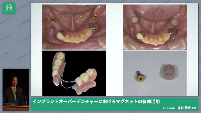 インプラントオーバーデンチャーにおけるマグネットの有効活用 鬼村 朋宏先生