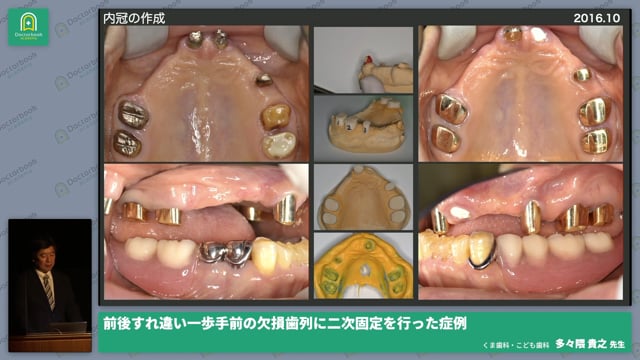 前後すれ違い一歩手前の欠損歯列に二次固定を行った症例 多々隈 貴之先生