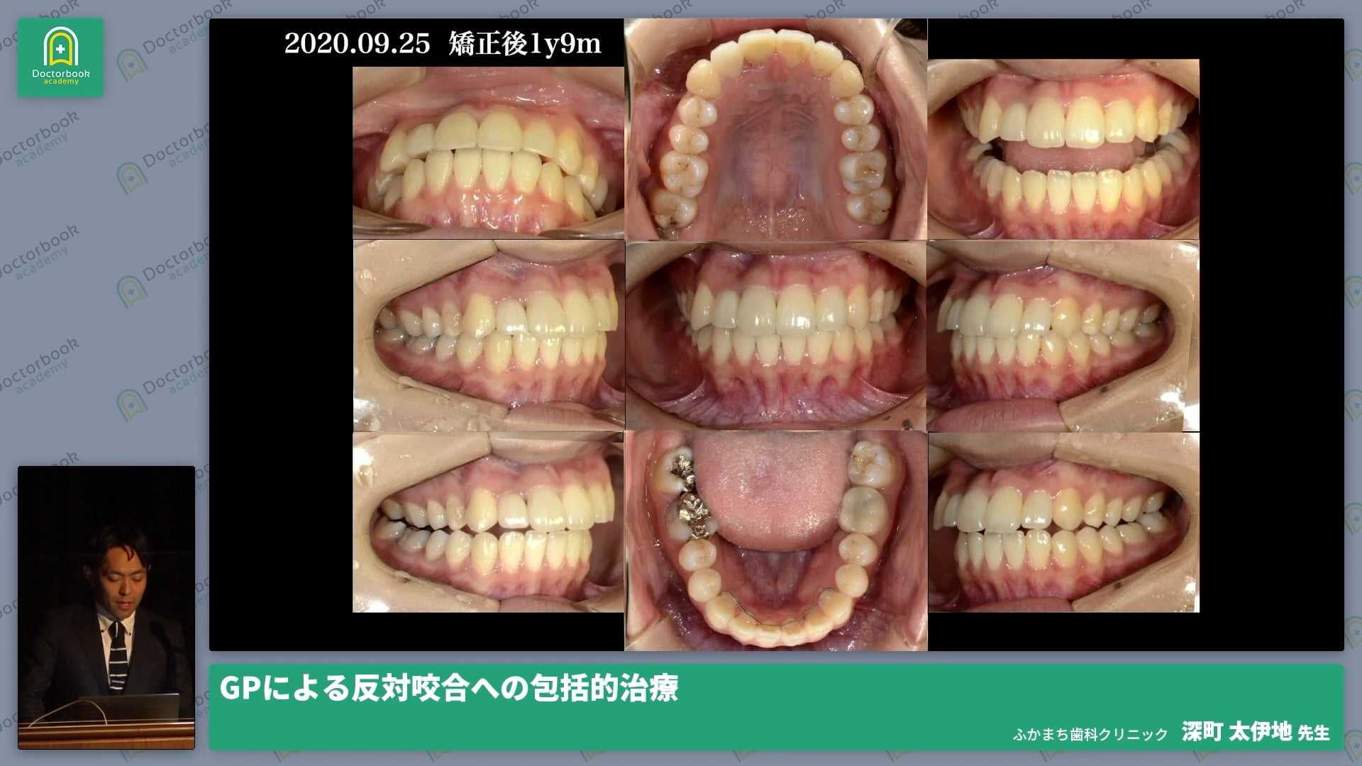 GPによる反対咬合への包括的治療 深町 太伊地先生