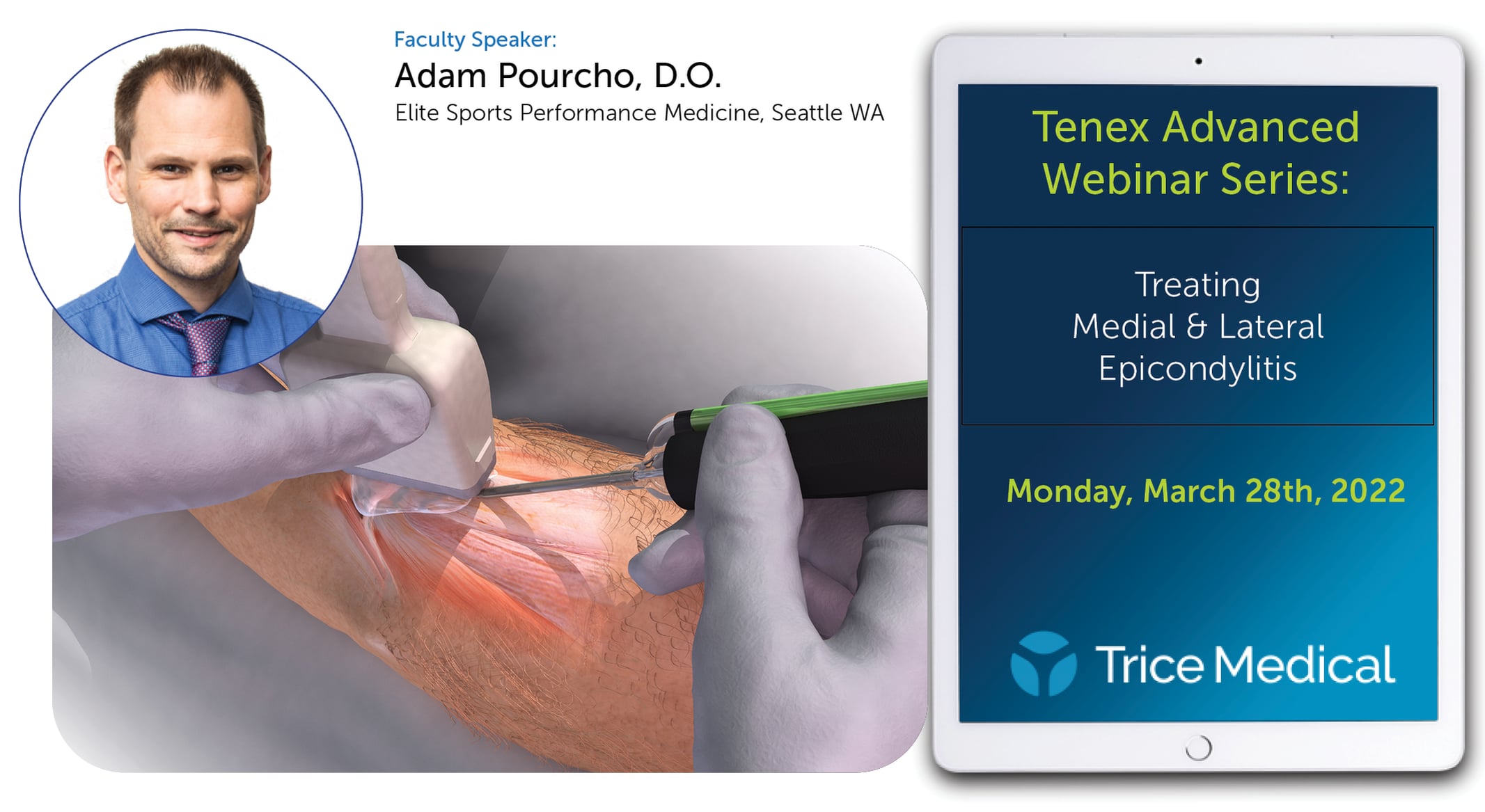 Tenex: Medial & Lateral Epicondylitis With Dr. Adam Pourcho On Vimeo