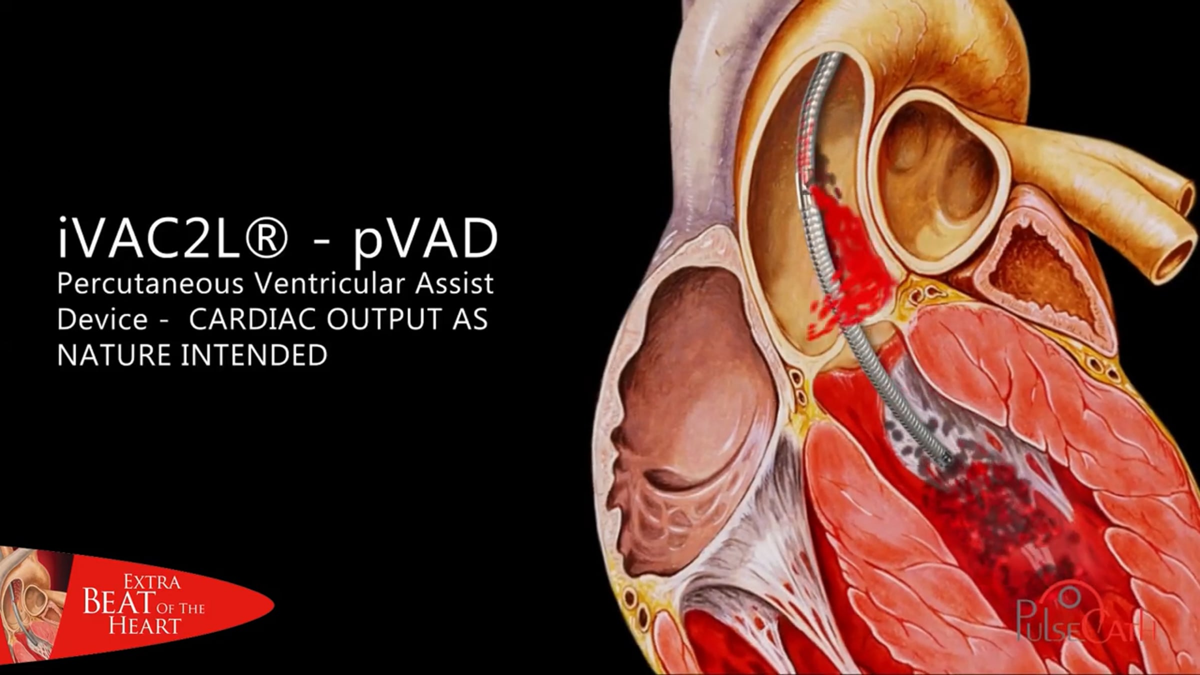 PulseCath iVAC2L -pVAD animation.mp4 | Videos & Movies on Vimeo