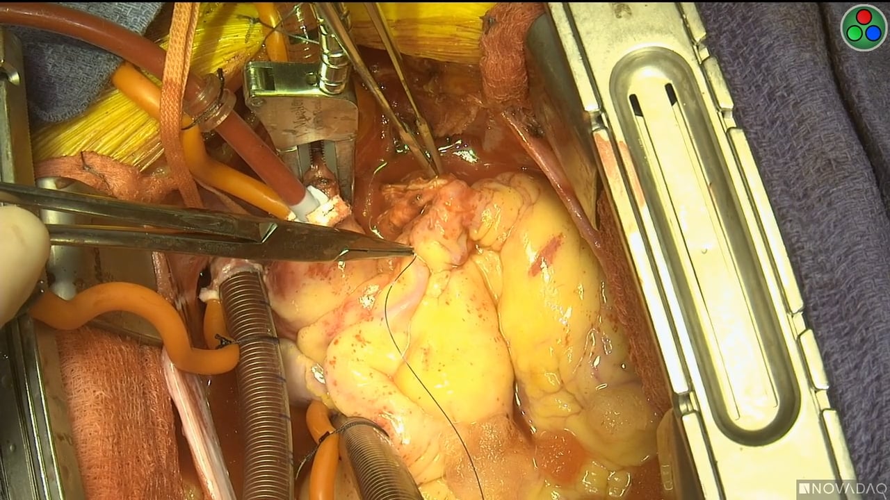 Braz J Cardiovasc Surg - The pulmonary vascular blood supply in