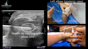 Elbow Joint Injection Posterior Approach
