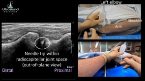 Radiocapitellar Joint Injection