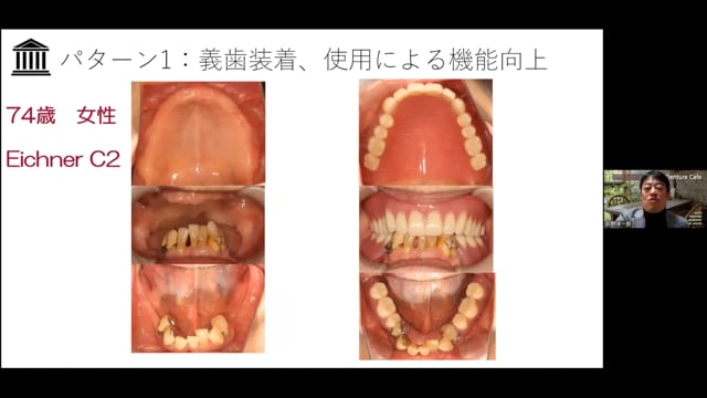 高齢者の義歯とオーラルリハビリテーション│荻野 洋一郎先生 #1