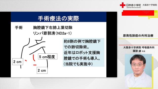 原発性肺癌の外科治療