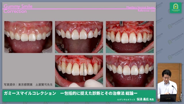 硬組織の骨によるガミースマイルに対する診断及び治療方法