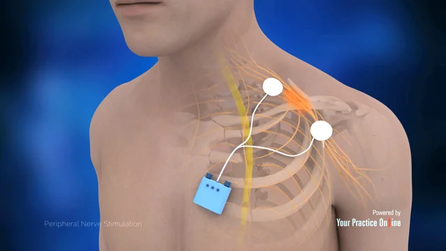 Spinal Column and Peripheral Nerve Stimulator - Back Pain Treatment