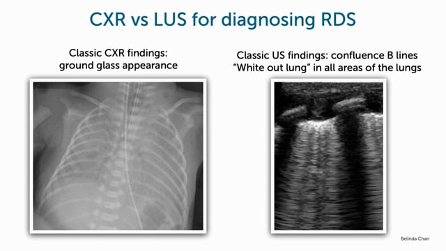 What does neonatal respiratory distress syndrome look like on ultrasound compared to chest X-ray?