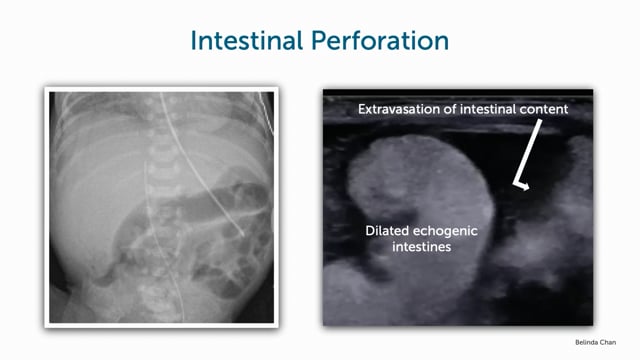 Case of intestinal perforation in a newborn