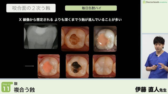 複合う蝕│Step4-11