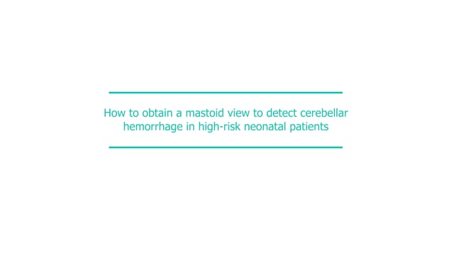 How to obtain a mastoid view to detect cerebellar hemorrhage in high-risk neonatal patients