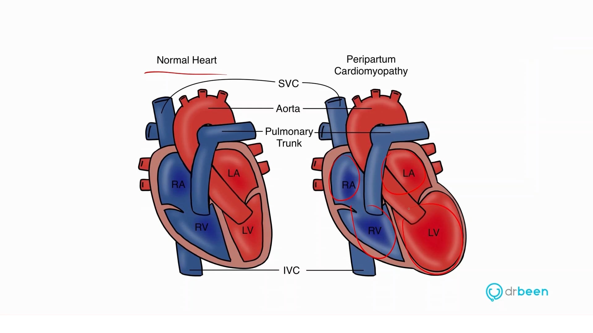 Peripartum Cardiomyopathy (Dr. Bhatti)