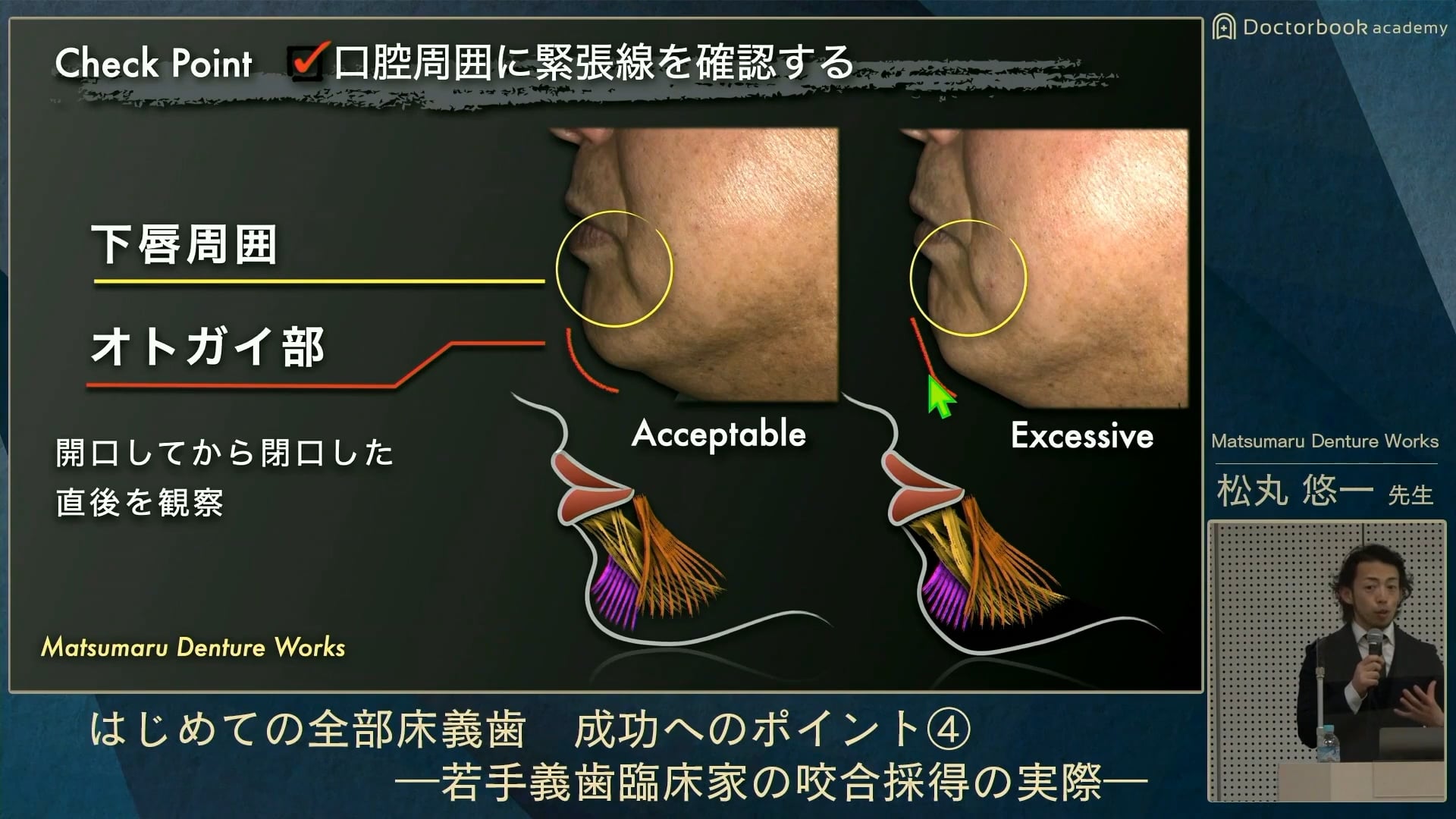 咬合床にこだわる咬合採得│松丸 悠一先生