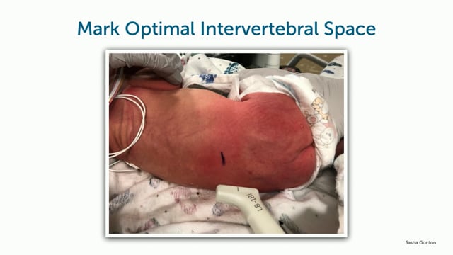 How to find the optimal lumbar puncture site