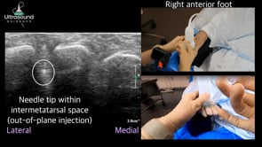 Intermetatarsal Injection