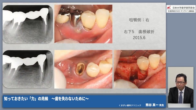 症状を引き起こす「力」とは｜偏咀嚼 #1