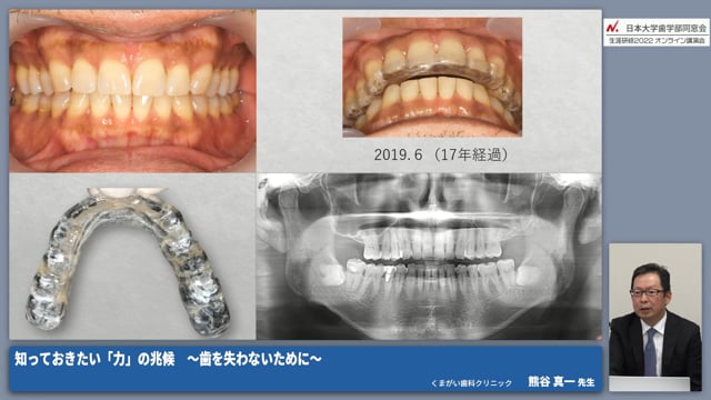 力を受ける側に現れる兆候とその対策｜歯周組織 #3