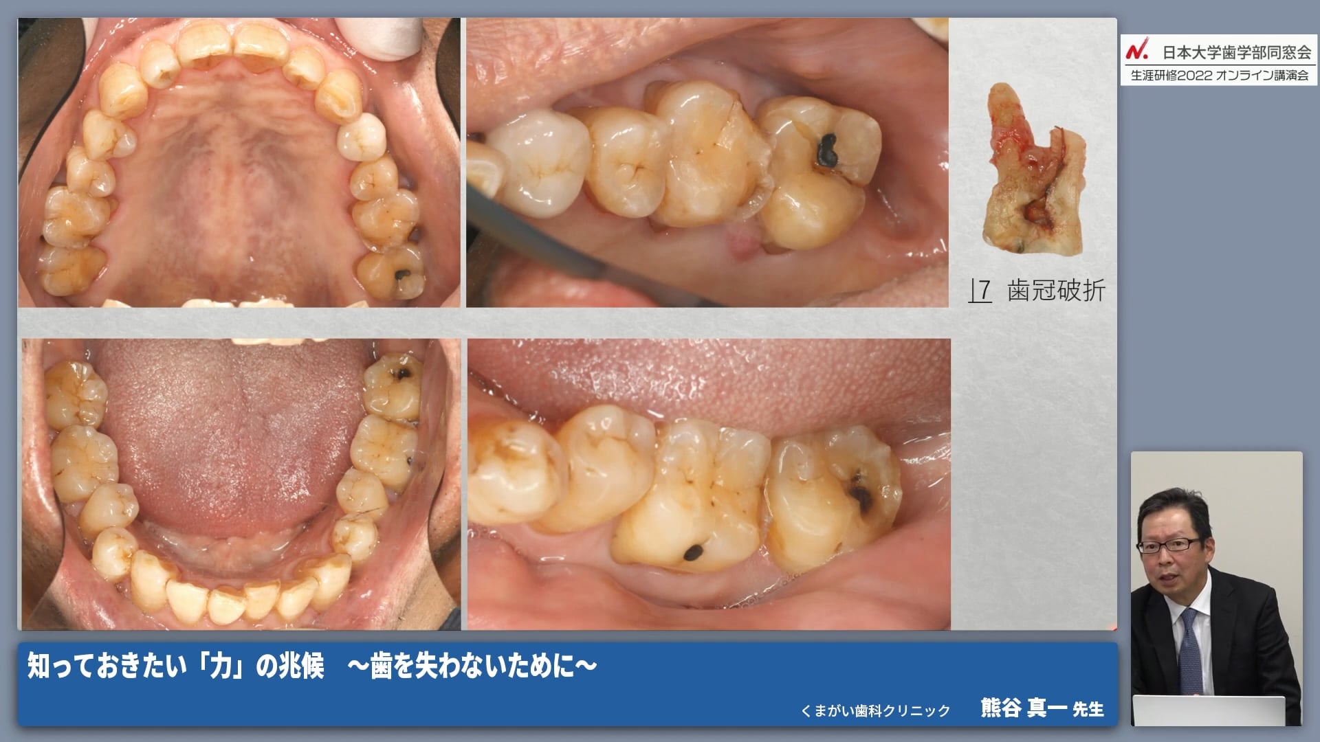 力を受ける側に現れる兆候とその対策｜ 顎関節 #5