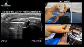 Radiocarpal and Distal Radioulnar Joint Injection