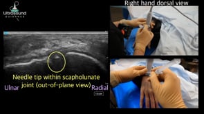 Scapholunate Joint Injection