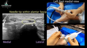 Plantar Fascia Injection