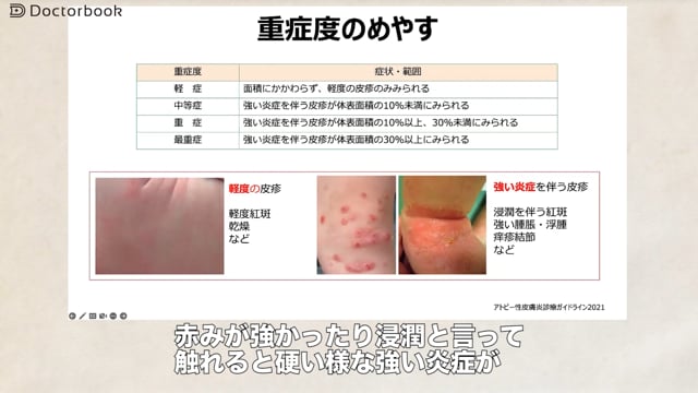 アトピー性皮膚炎の診断・治療について