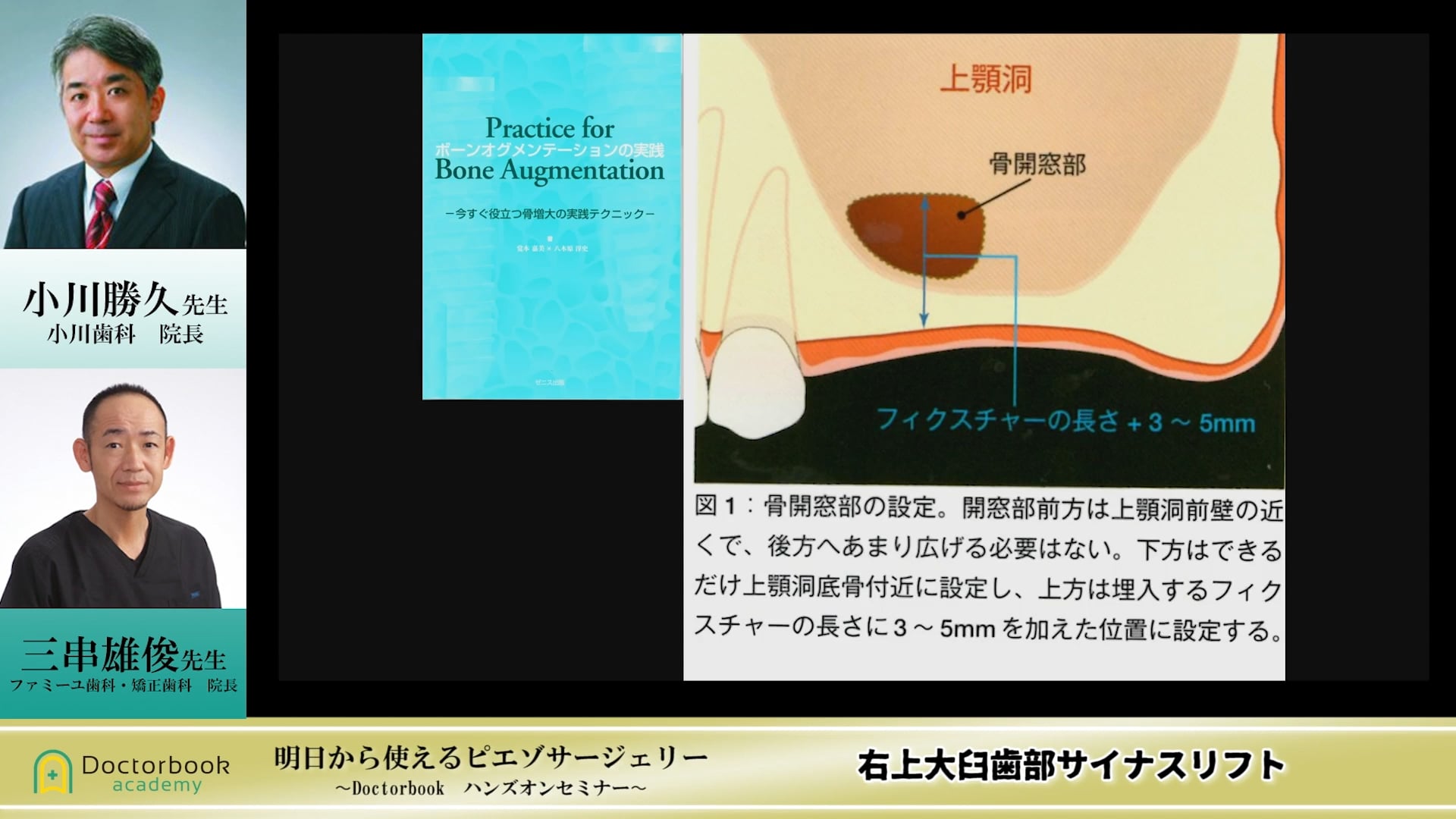  臨床知見録_サイナスリフト_サイナスリフトの術式