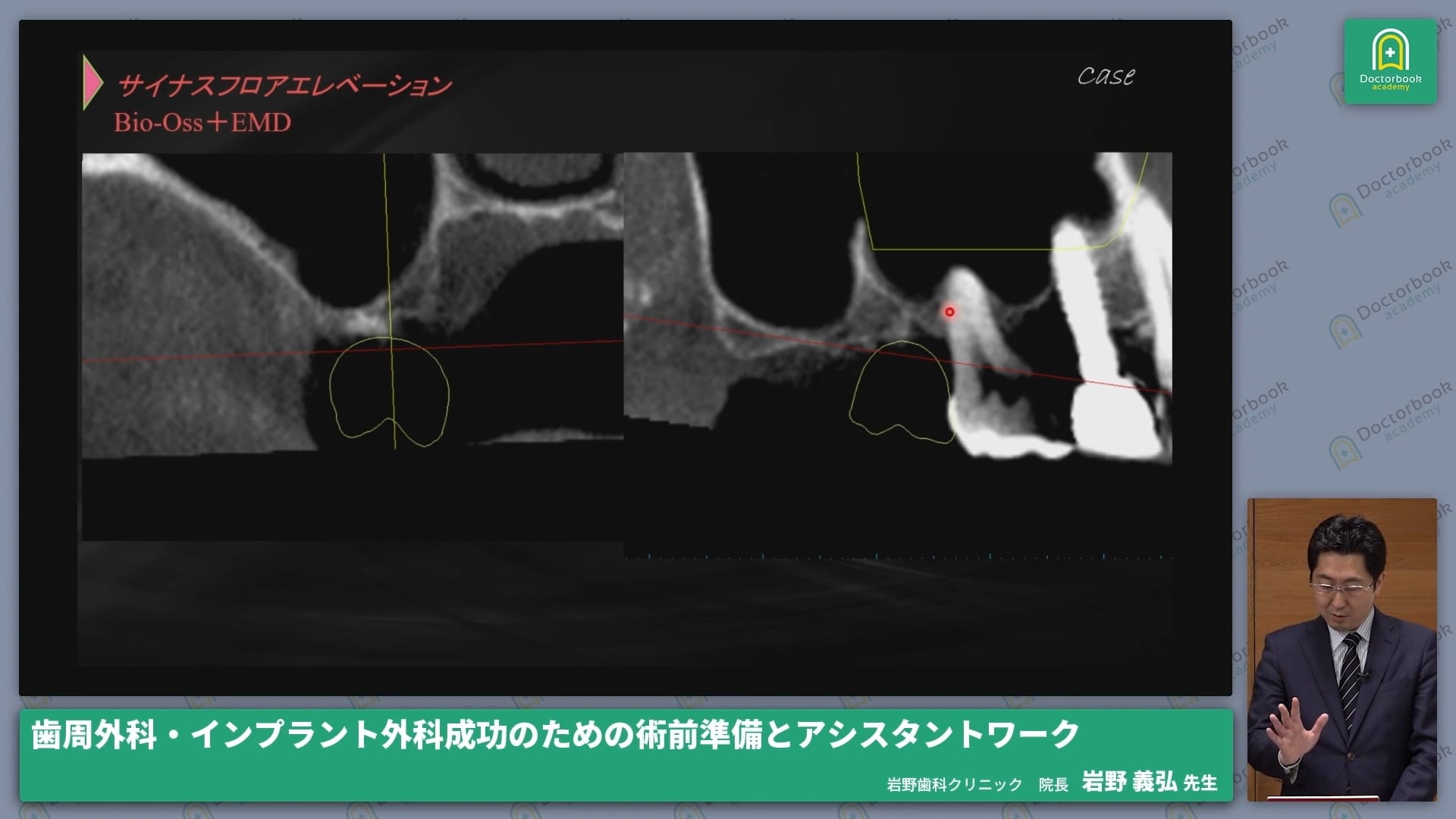  臨床知見録_サイナスリフト_副鼻腔 解剖