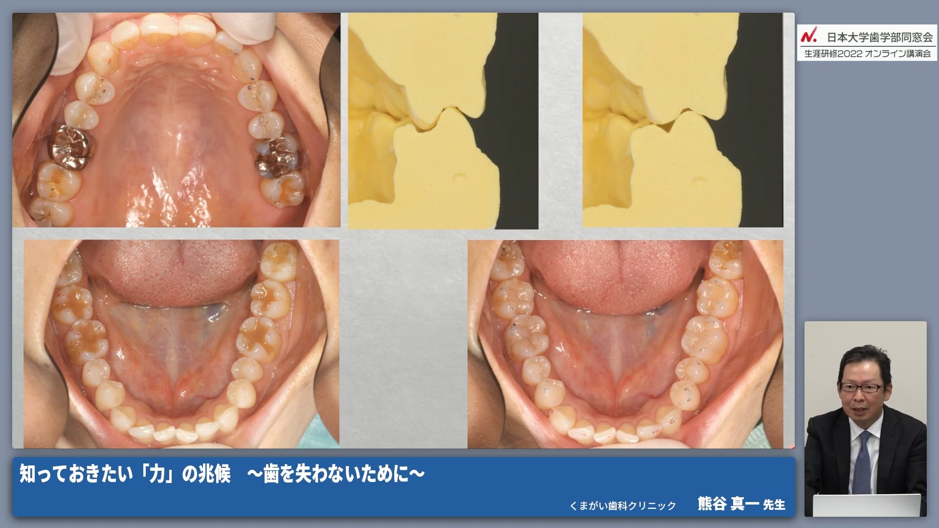 力を受ける側に現れる兆候とその対策｜歯・歯列 #4