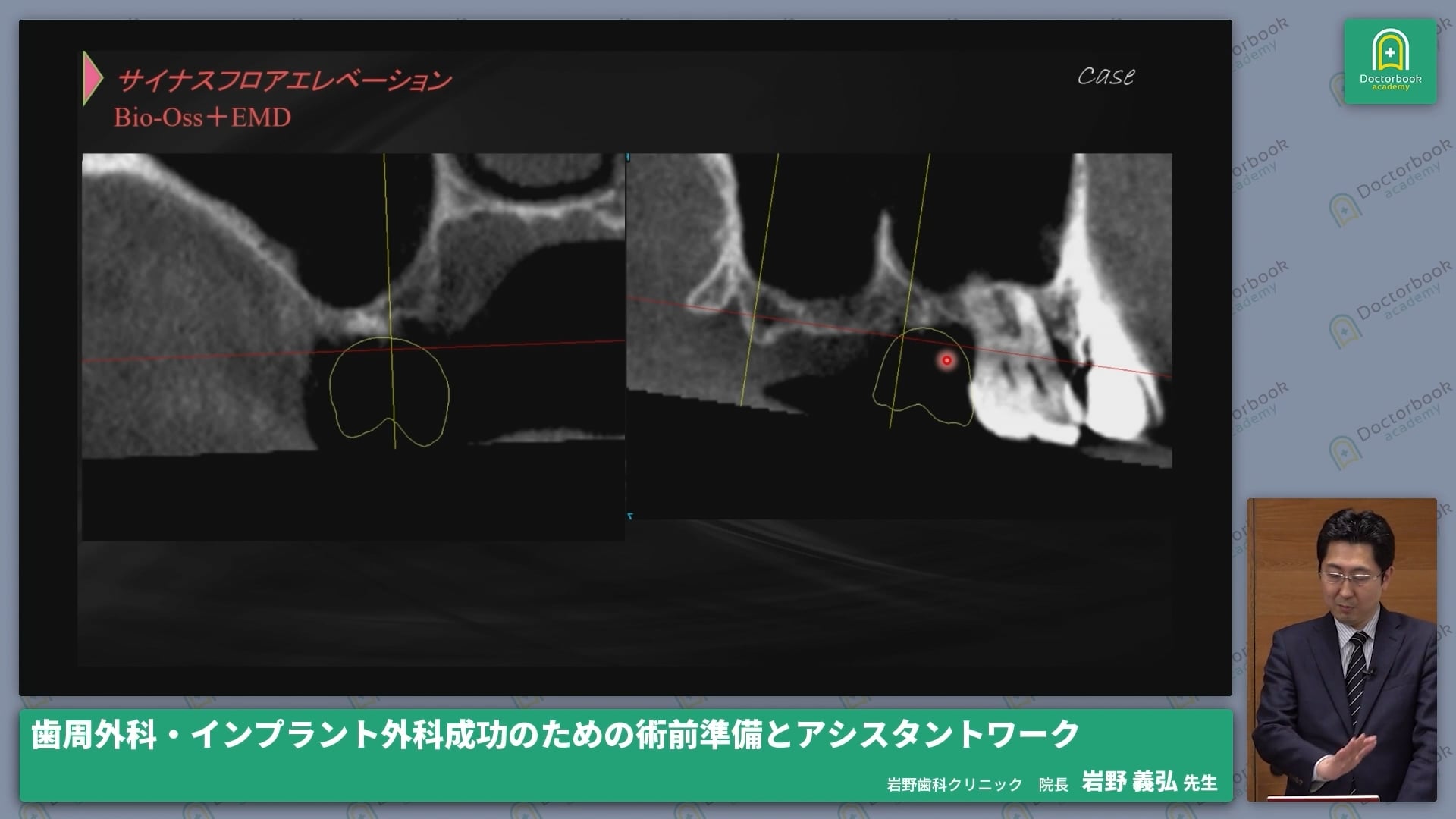  臨床知見録_サイナスリフト_【症例】ラテラルアプローチとバーティカルアプローチの適応