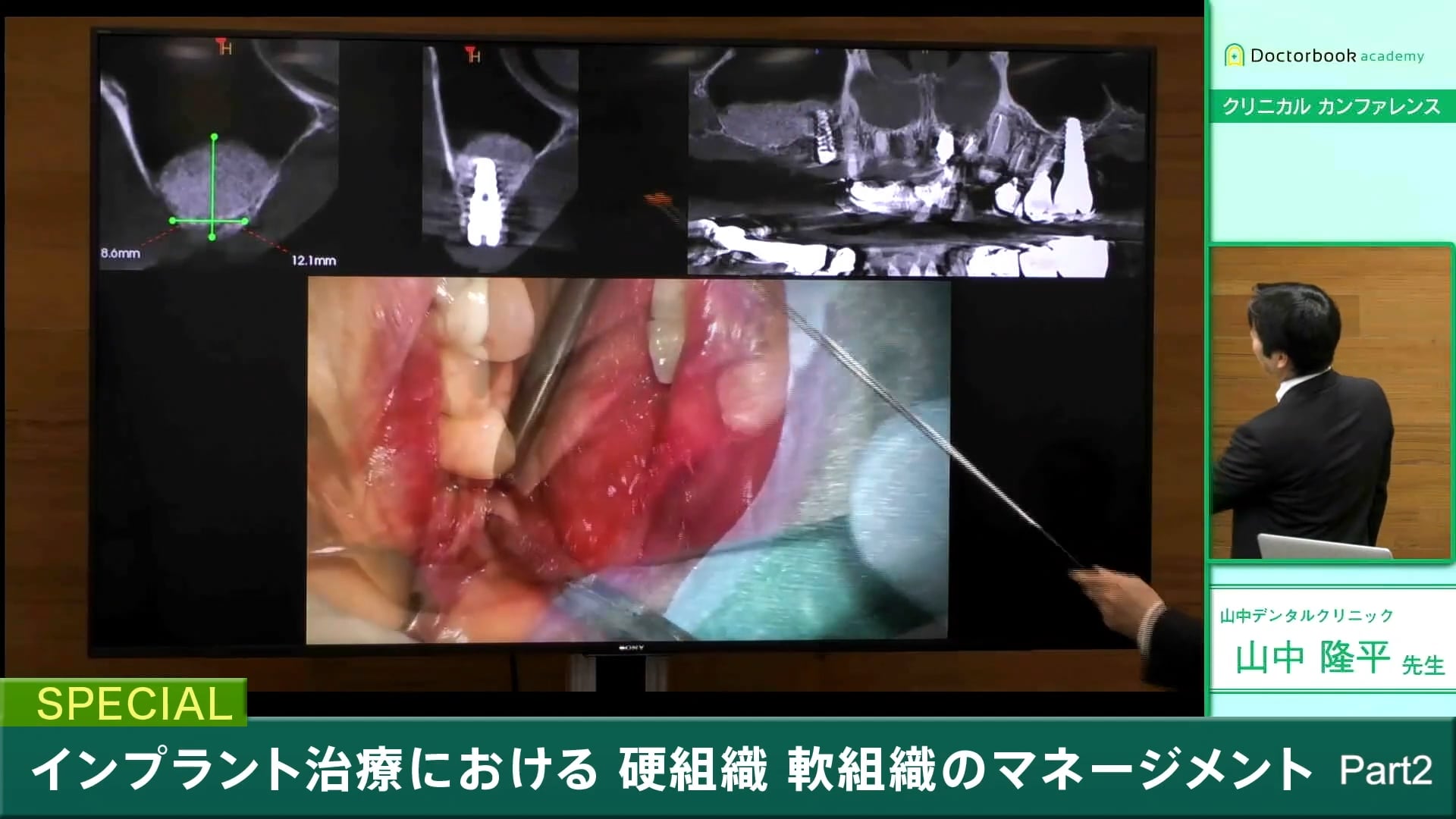  臨床知見録_サイナスリフト_剥離子と、 剥離時の器具の使い方