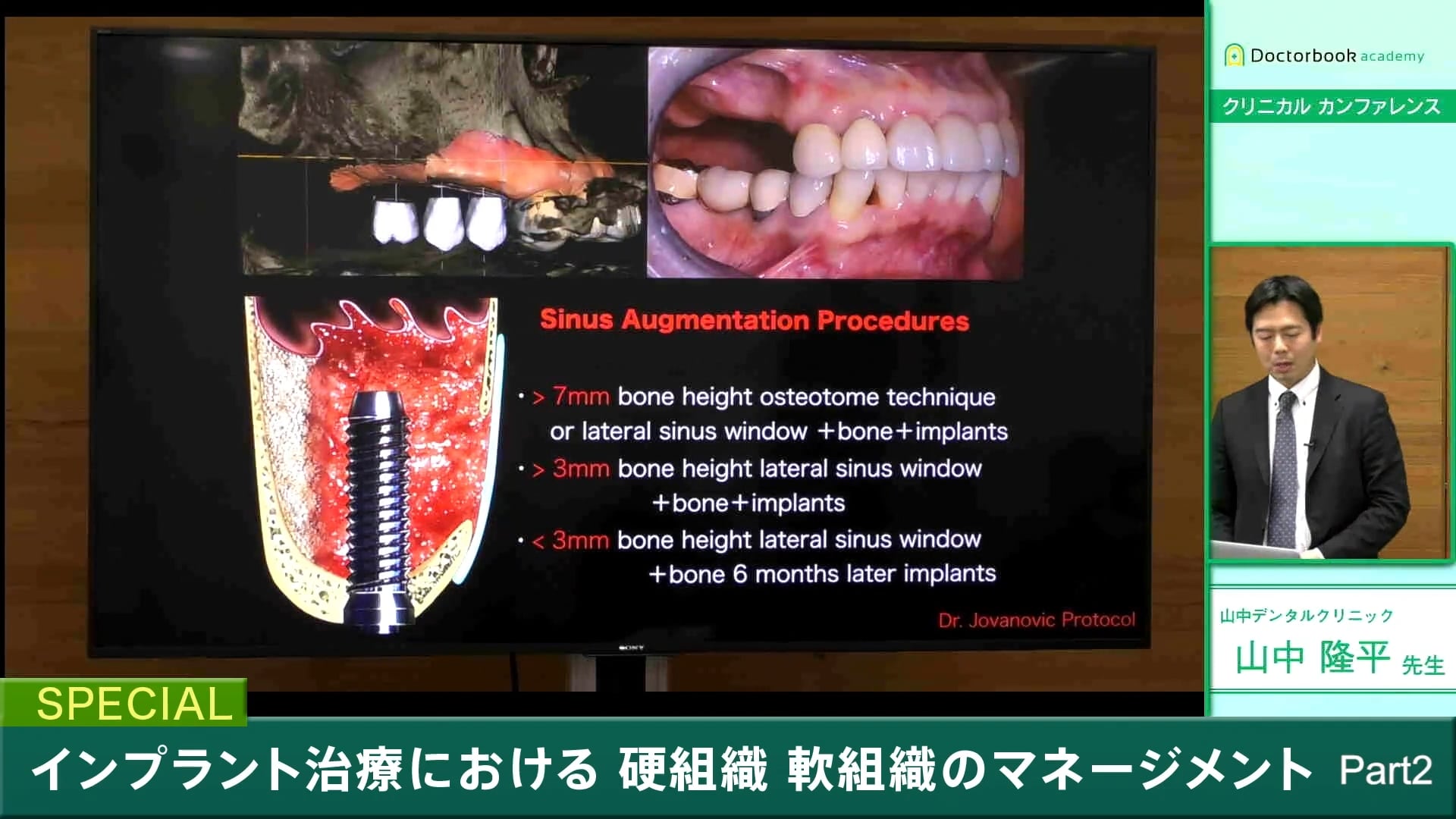  臨床知見録_サイナスリフト_クレスタルアプローチとの⽐較#3_サイナスリフト