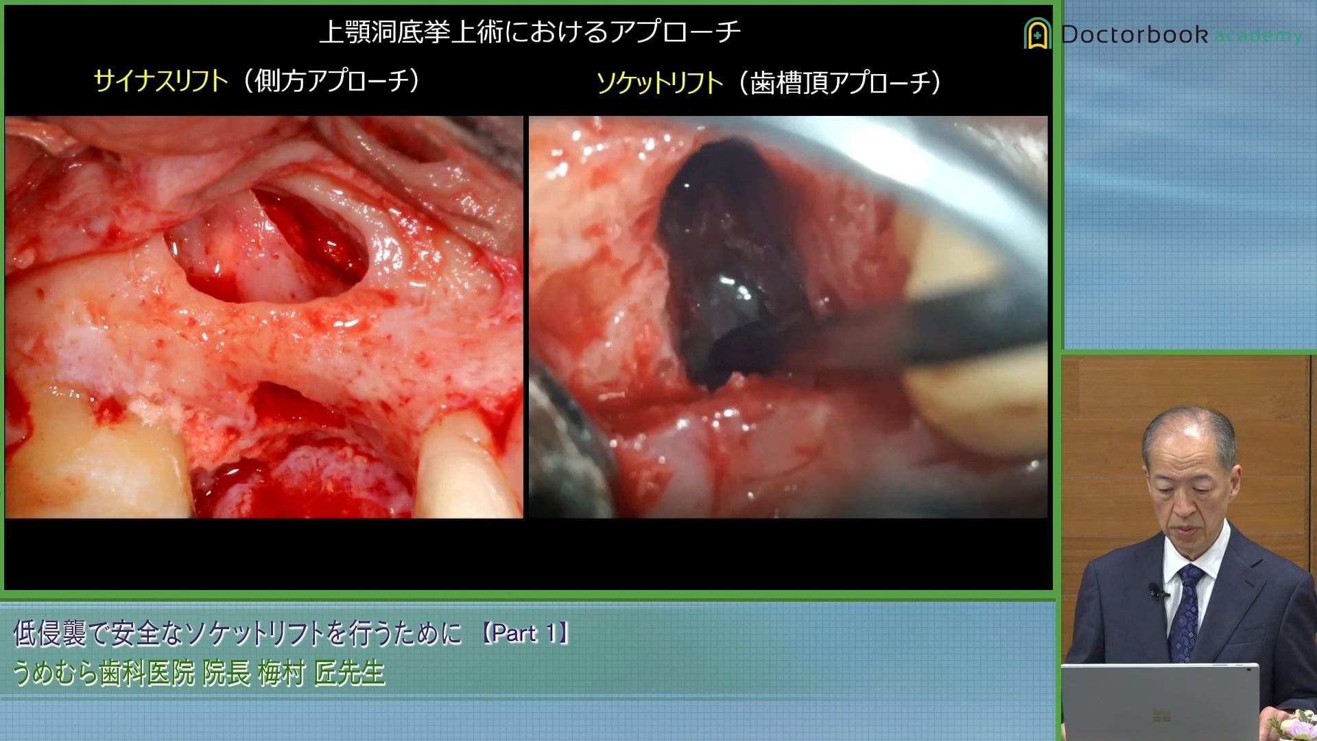  臨床知見録_サイナスリフト_クレスタルアプローチとの⽐較#1