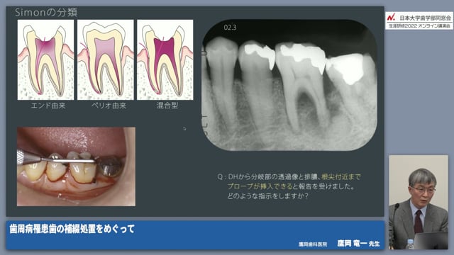 垂直性骨欠損と補綴物 #2