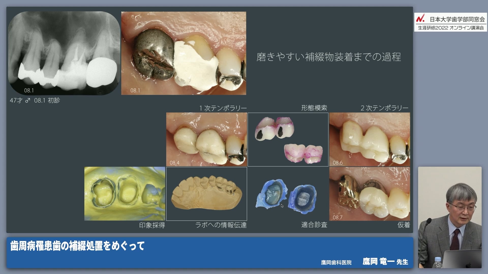 知っておきたい補綴の基礎知識 #3