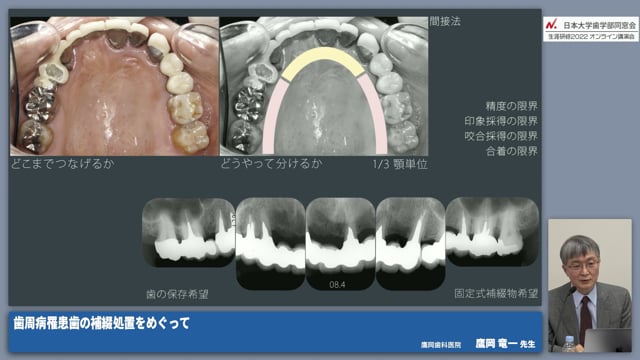 歯周病の治りやすさと補綴処置 #5